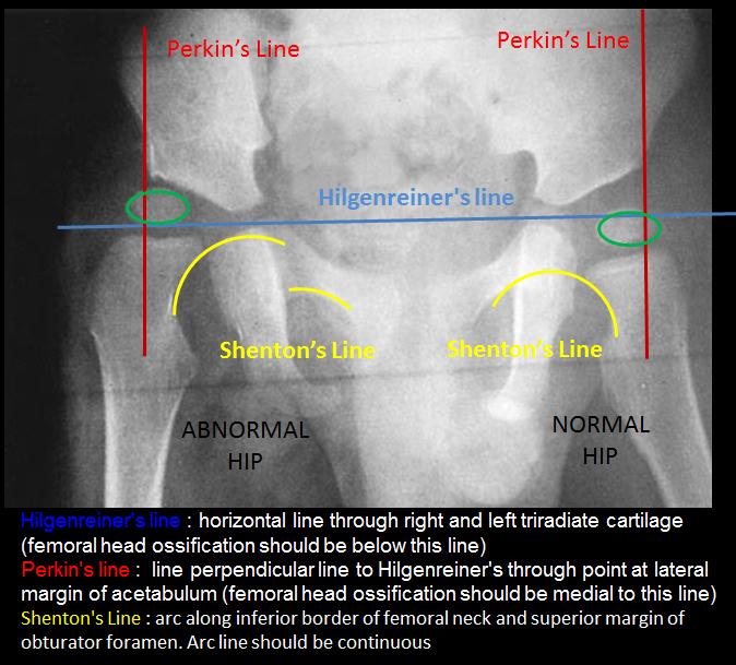 Hip Septic Arthritis Pediatric Pediatrics Orthobullets